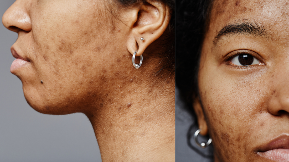 Understanding Why Acne Keeps Coming Back